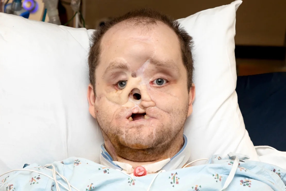 Before his face transplant surgery, Derek Pfaff was missing several parts of his face. | Mayo Clinic