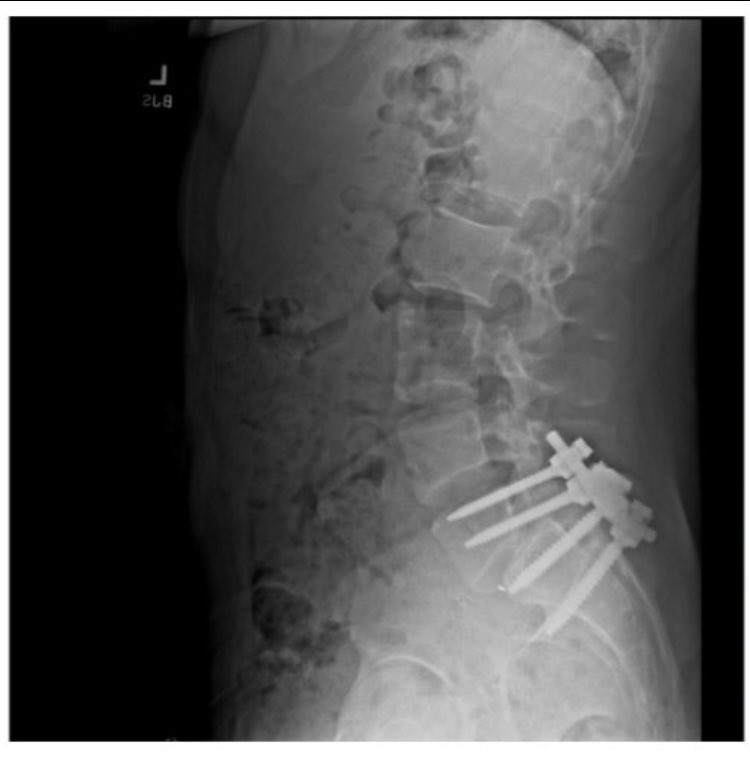 A x-ray of a spinal cord which has reinforcements shared by Luigi Mangione on social media, healthcare system